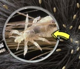 kode alam mimpi kutu rambut